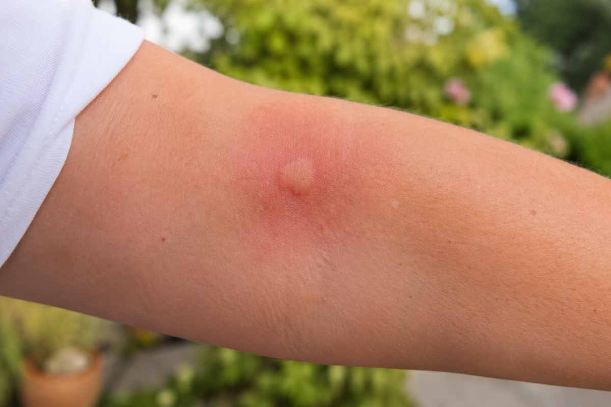 štípnutí od vosy na ruce